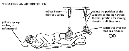 'FLOATING' AN ARTHRITIC LEG