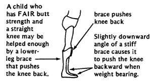 A child who has FAIR butt strength and a straight knee may be helped enough by a lower-leg brace that pushes the knee back. 