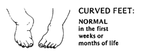 Curved feet: Noraml in the first weeks or months of life.