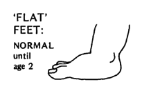'Flat' feet: Normal util age 2.