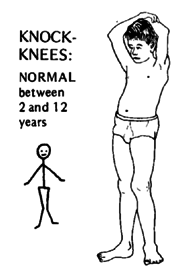 how to solve the problem of knock knee