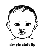 Simple cleft lip.