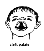 Cleft palate.