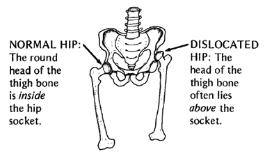 NORMAL HIP: The round head of the thigh bone is inside the hip socket, DISLOCATED HIP: The head of the thigh bone often lies above tne socket.