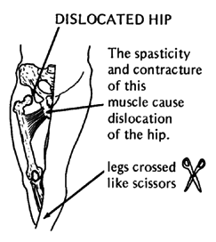 DISLOCATED HIP
