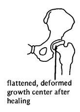 Flattened, deformed growth center after healing.