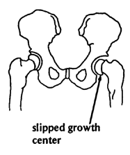 Slipped growth center