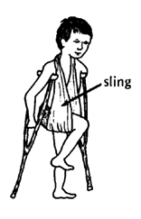 An old method was to prevent weight bearing and keep the hip bent in a sling.