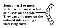 Sometimes 2 or more vertebrae remain attached or 'fused' on one side. They can only grow on the unfused side, causing an increasing curve.