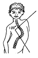 Measure and record the angle of the spinal curve.