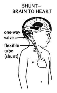 SHUNT - BRAIN TO HEART