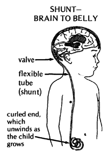 SHUNT - BRAIN TO BELLY