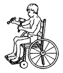 Paraplegia