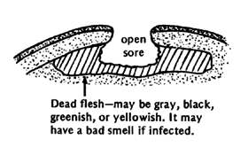 Dead flesh may be gray, black, greenish, or yellowish.