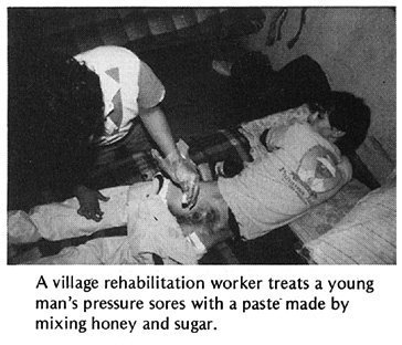 A village rehabilitation worker treats a young man's pressure sores with a paste made by mixing honey and sugar.