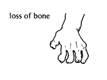 Loss of bone