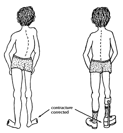 Contracture corrected.