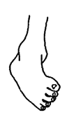 The foot with spstic cerebral palsy.