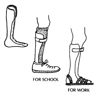 Plastic braces (for school and work)