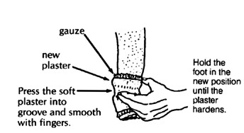 Hold the foot in the new position until the plaster hardens.