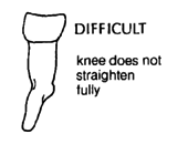 Fitting a limb - DIFFICULT