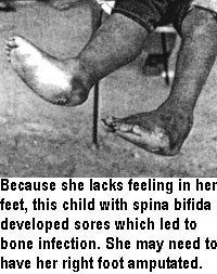 Because she lacks feeling in her feet, this child with spina bifida developed sores which led to bone infection. She may need to have her right foot amputated.