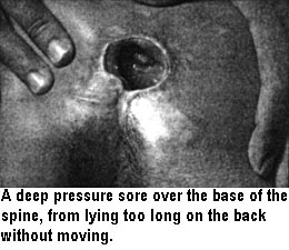 A deep pressure sore over the base of the spine, from lying too long on the back without moving.
