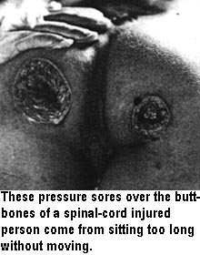 These pressure sores over the butt-bones of a spinal-cord injured person come from sitting too long without moving.